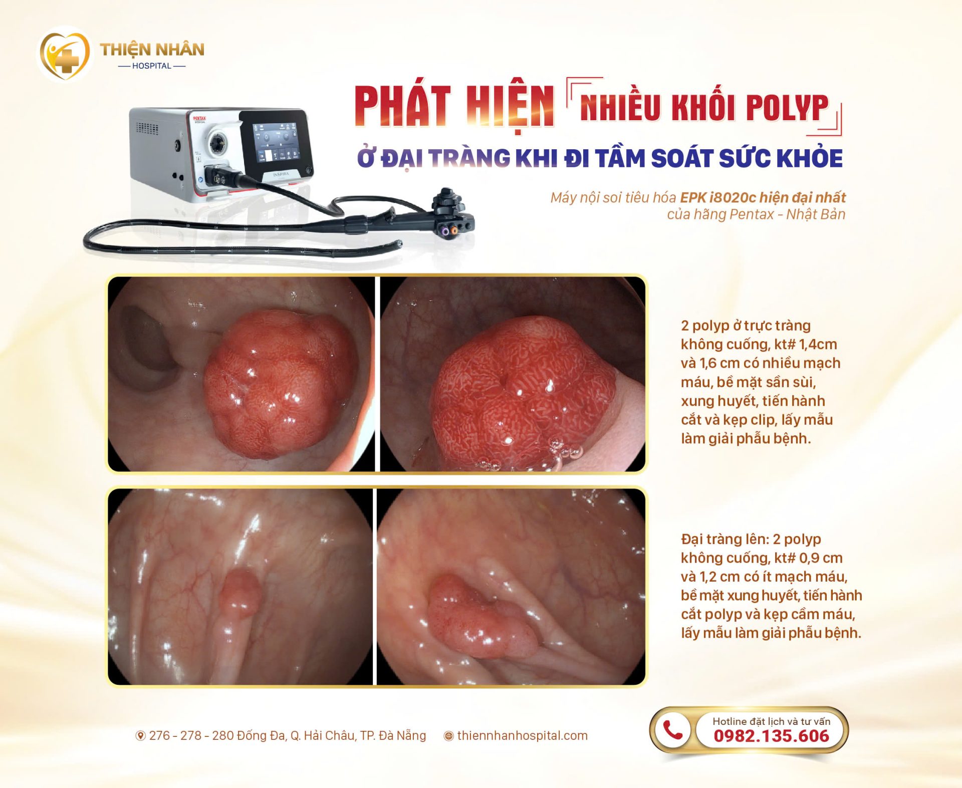 PH T HI N KH I POLYP I TR NG KHI I KH M S C KH E PH T HI N KH I POLYP I TR NG KHI I KH M S C KH E