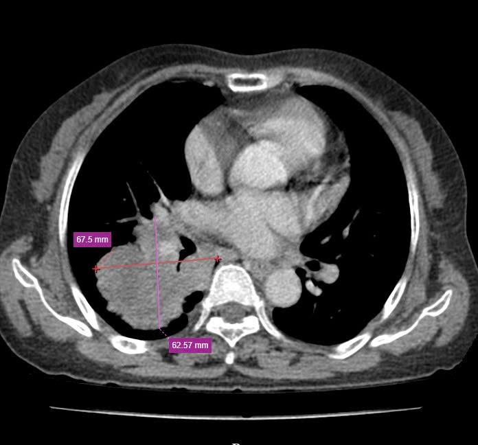 phát hiện ung thư phổi di căng