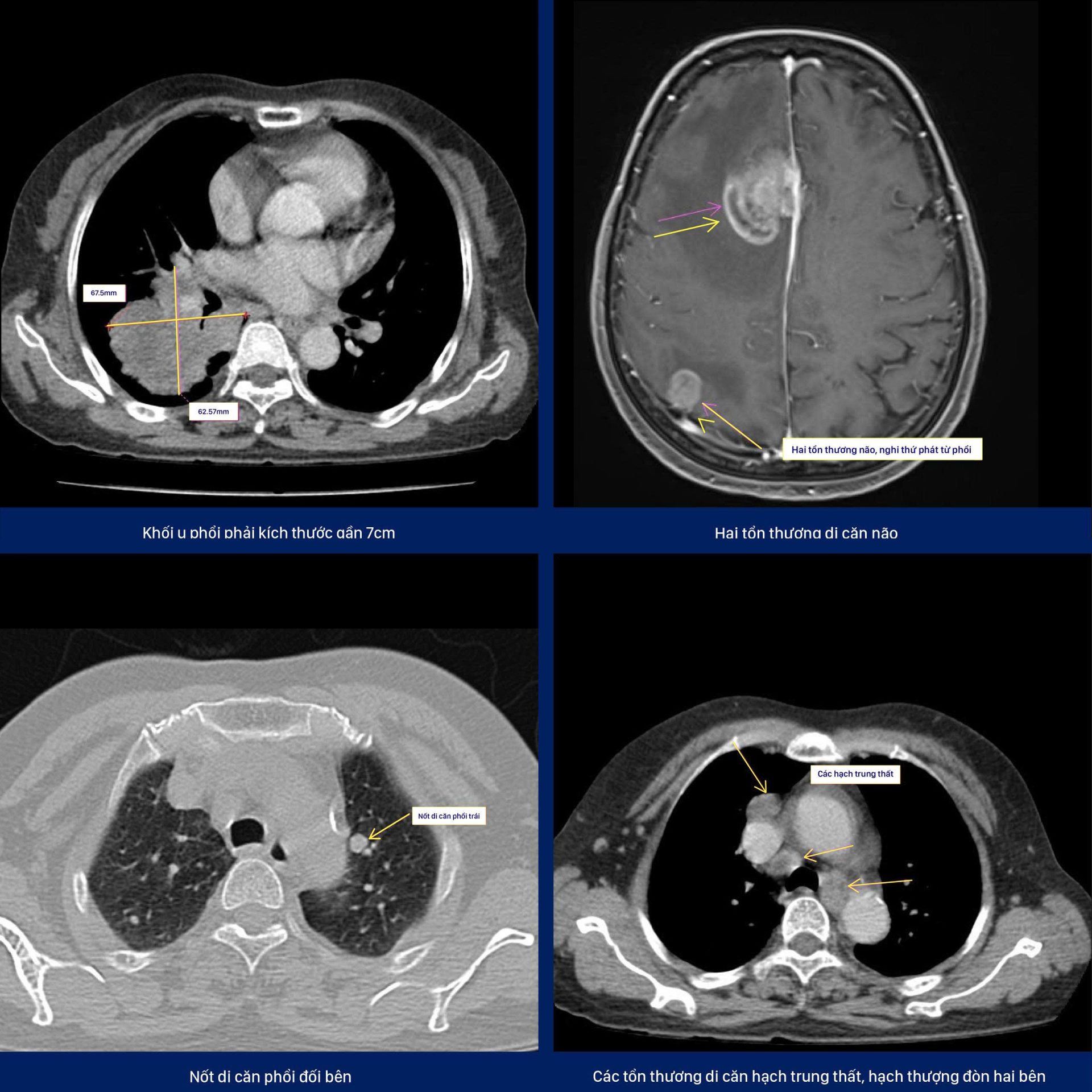 CHỤP CT NGỰC LIỀU THẤP – GIẢI PHÁP TẦM SOÁT UNG THƯ PHỔI SỚM