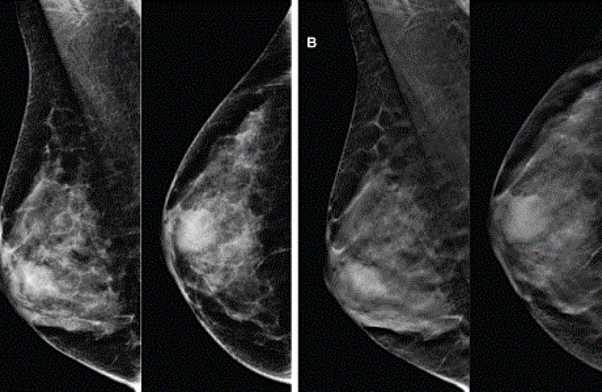 Chụp Nhũ ảnh 3D tại Thiện Nhân