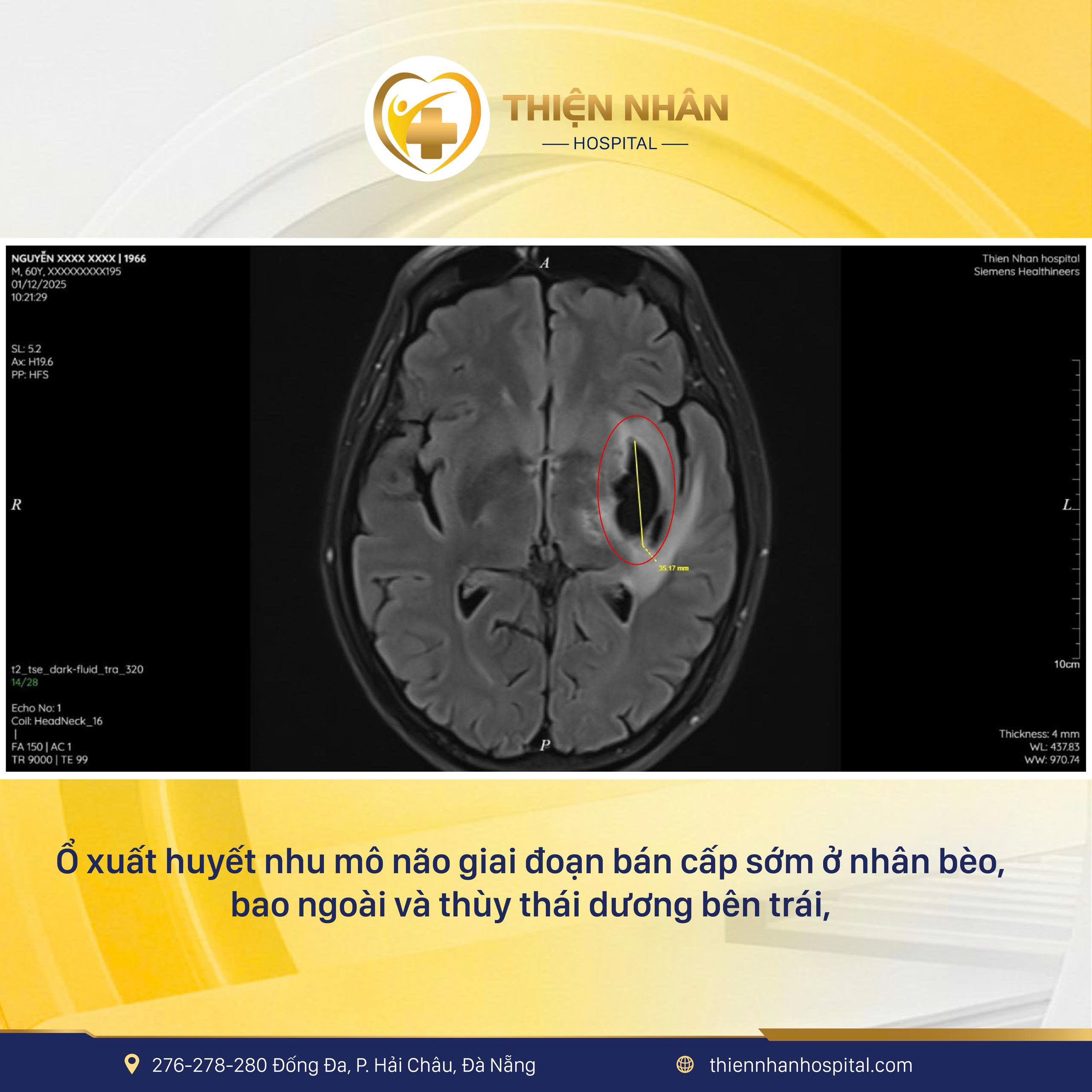 MRI não tại Thiện Nhân phát hiện đột quỵ