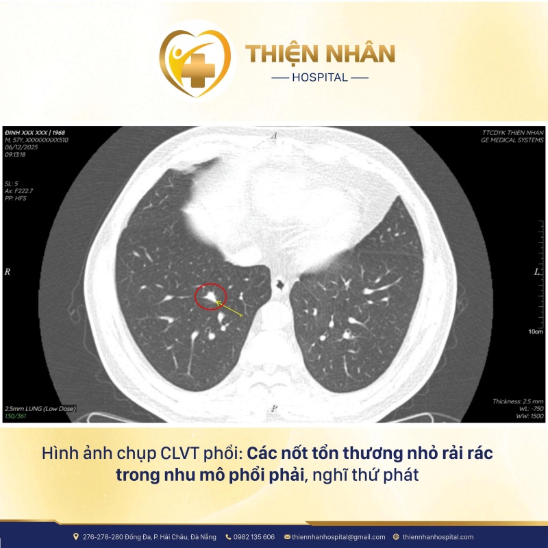Ảnh chụp CLVT phổi