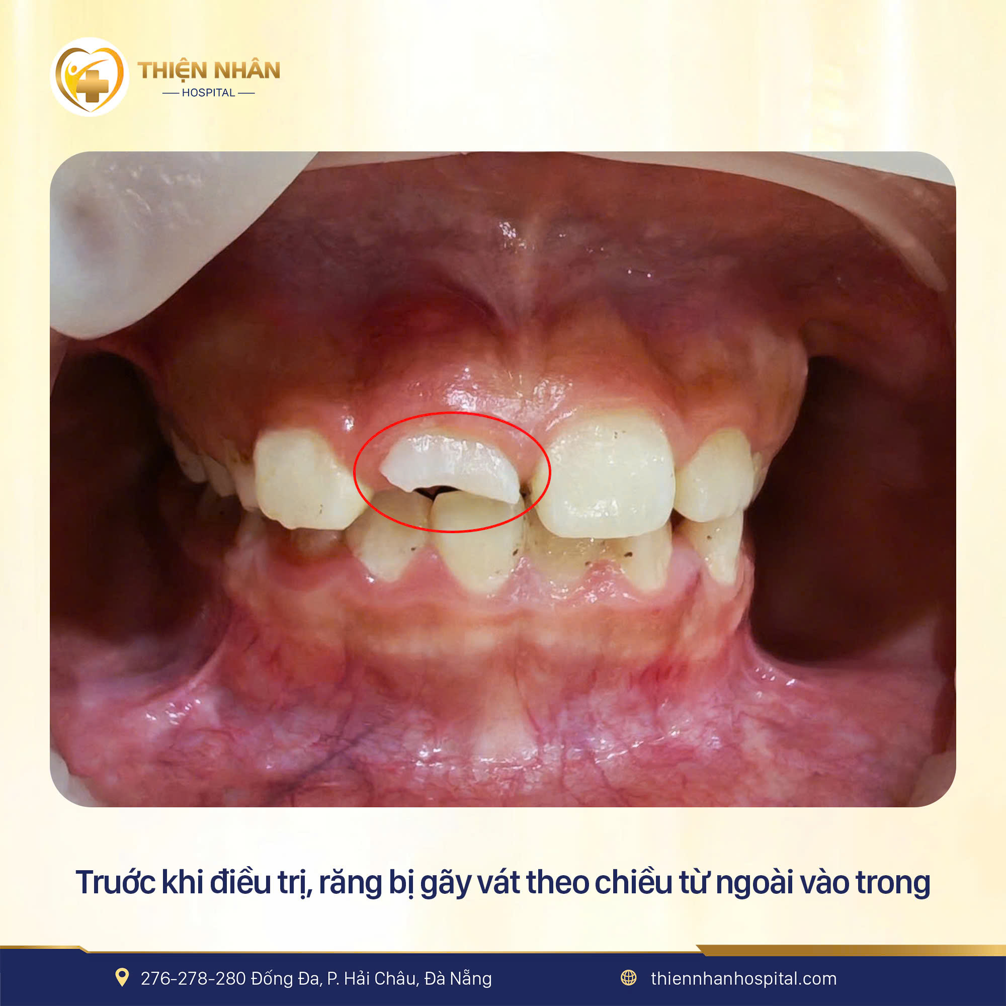 dieu-tri-rang-thien-nhan