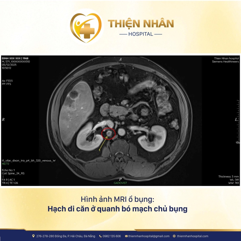 MRI ổ bụng