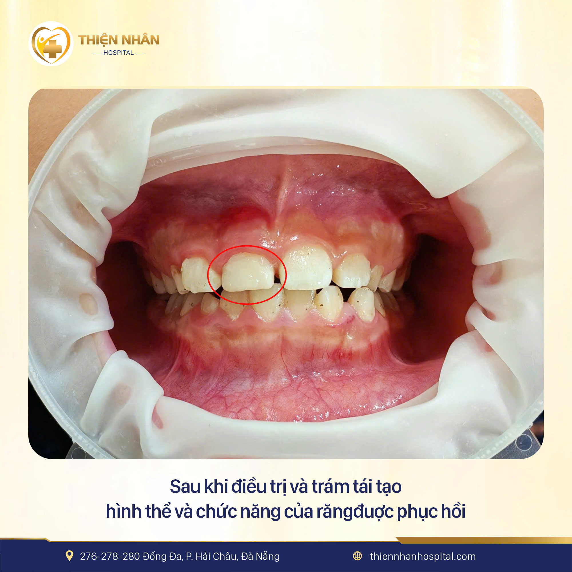 BÉ 7 TUỔI ĐAU NHỨC DỮ DỘI SAU CHẤN THƯƠNG RĂNG – MAY MẮN ĐƯỢC “CỨU RĂNG” KỊP THỜI TẠI THIỆN NHÂN