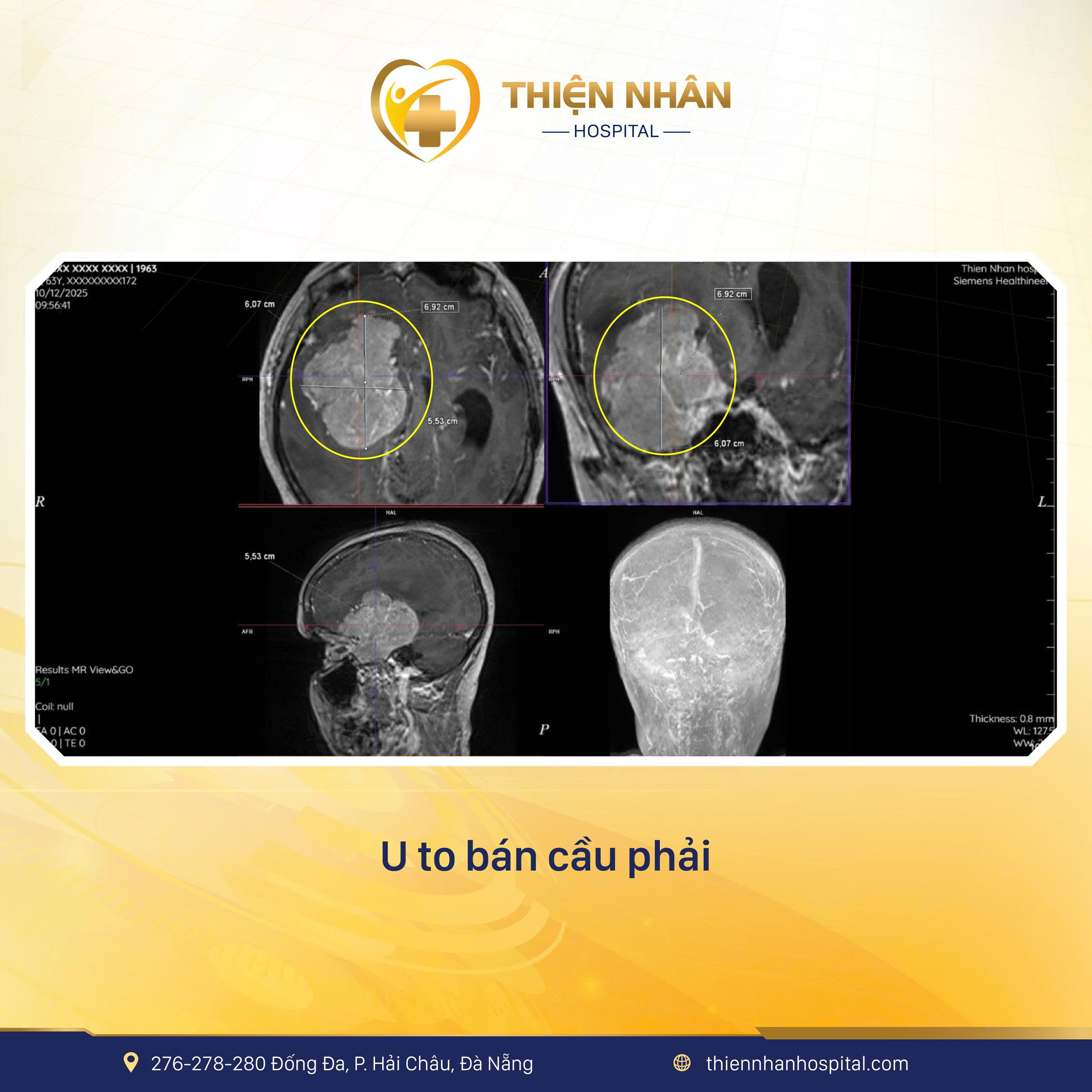 BỎ QUA NHỮNG DẤU HIỆU “NHẸ”, BỆNH NHÂN RƠI VÀO HÔN MÊ DO U MÀNG NÃO
