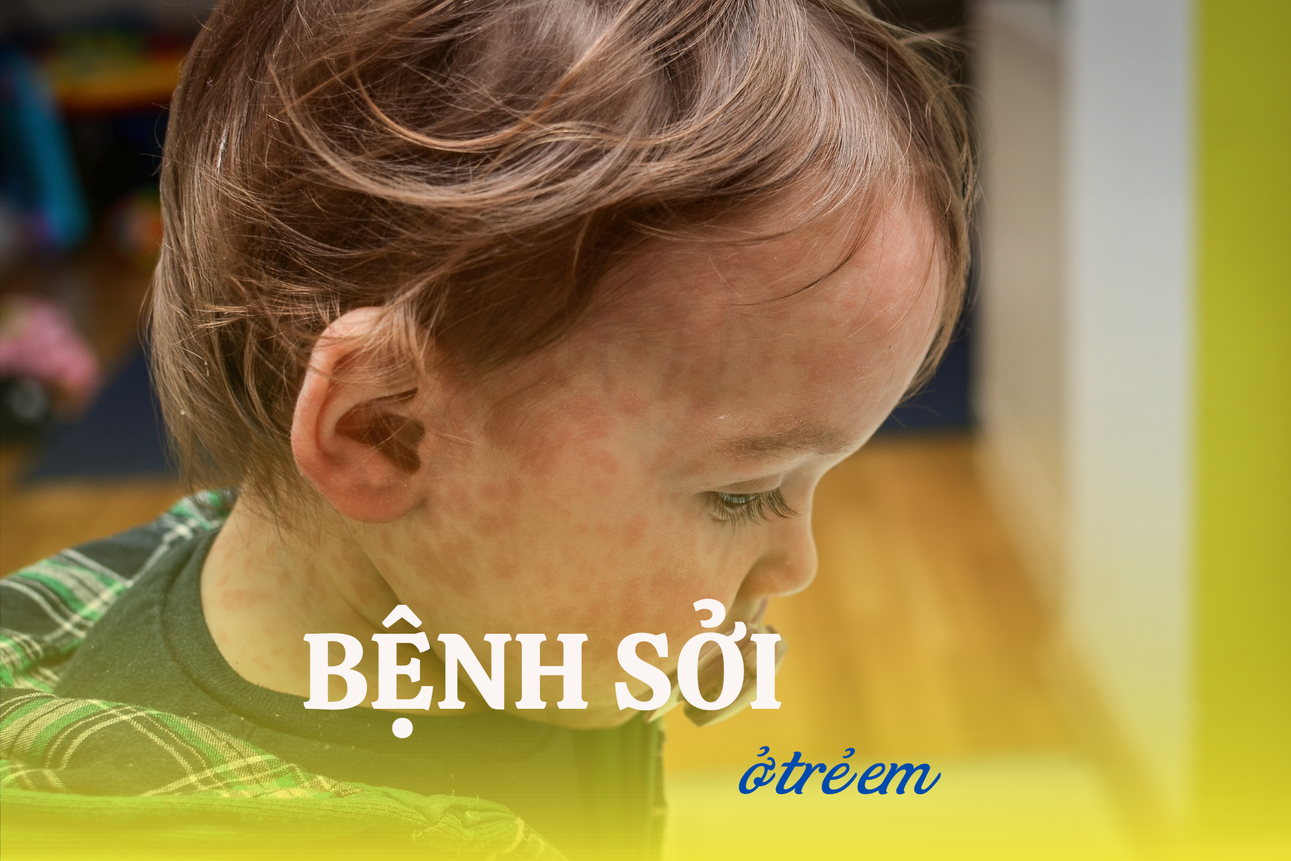 BỆNH SỞI Ở TRẺ EM: DẤU HIỆU, NGUYÊN NHÂN VÀ CÁCH CHẨN ĐOÁN